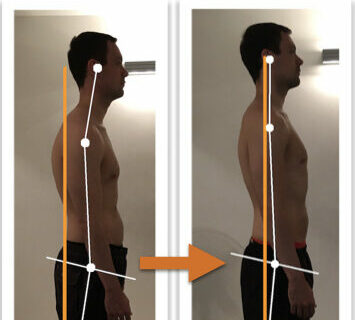 Before and after photos showing remarkable improvement of a man's body alignment from side view after posture correction therapy