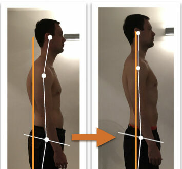 Before and after photos showing remarkable improvement of a man's body alignment from side view after posture correction therapy