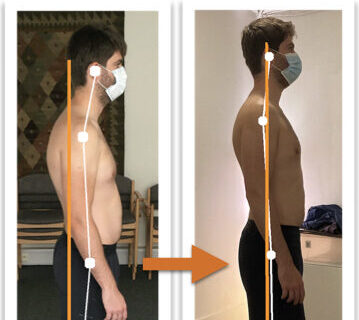 Cropped thumbnail showing before-and-after posture improvement in male client using posture correction therapy