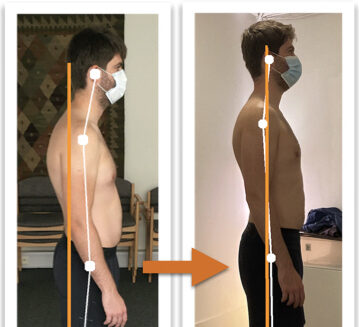 Cropped thumbnail showing before-and-after posture improvement in male client using posture correction therapy