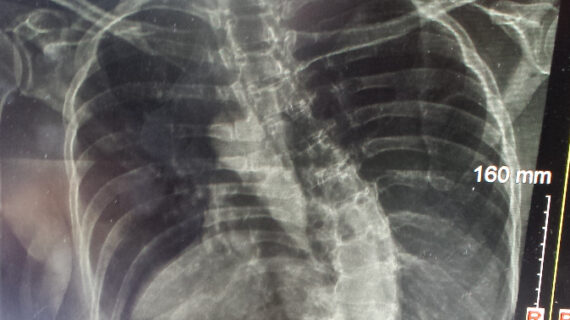 X-ray image showing a pronounced S-shaped scoliosis curvature in the spine of a 63-year-old woman before starting posture therapy.