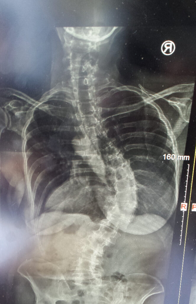 X-ray image showing a pronounced S-shaped scoliosis curvature in the spine of a 63-year-old woman before starting posture therapy.